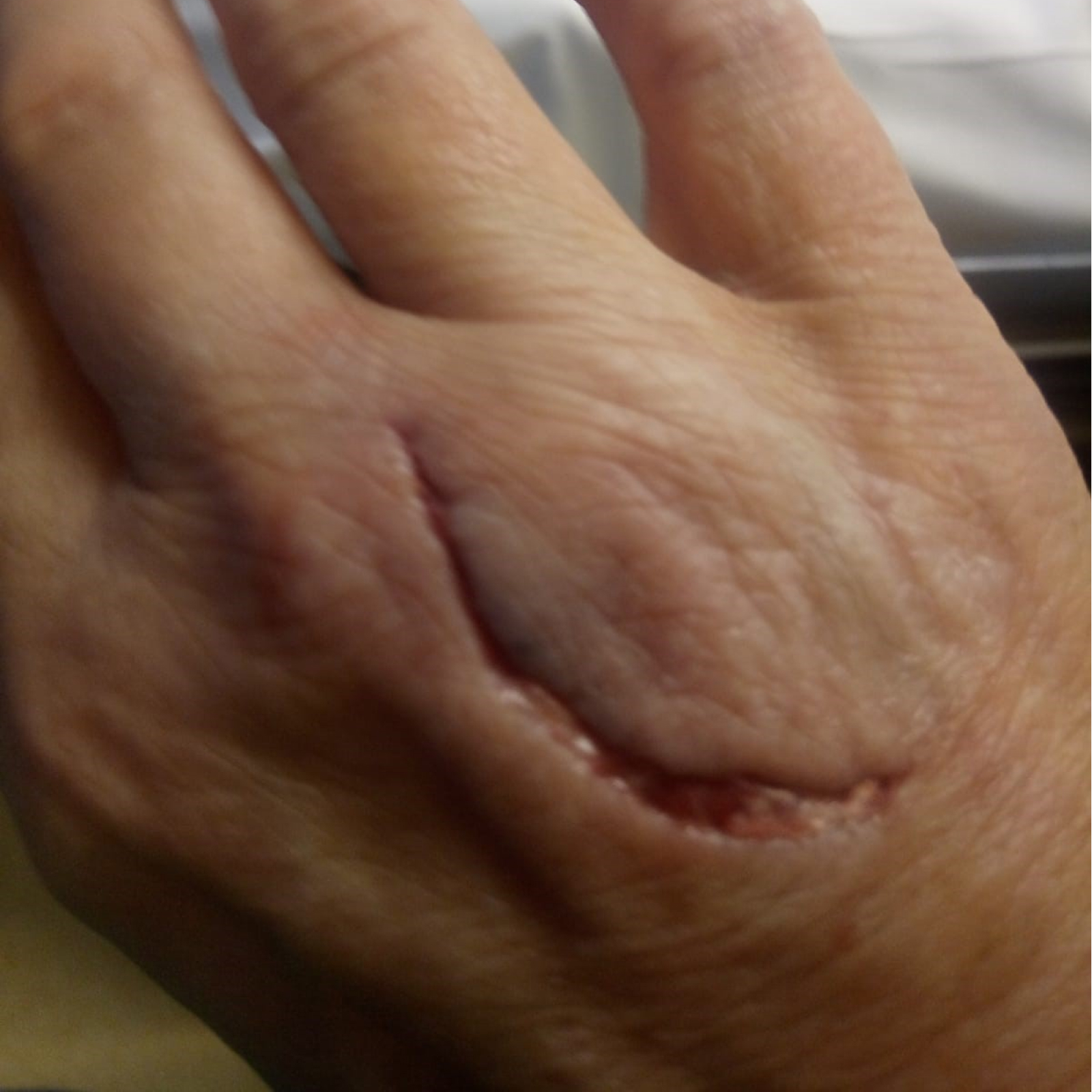 Trauma okozta heg – kutyaharapás – alapállapot