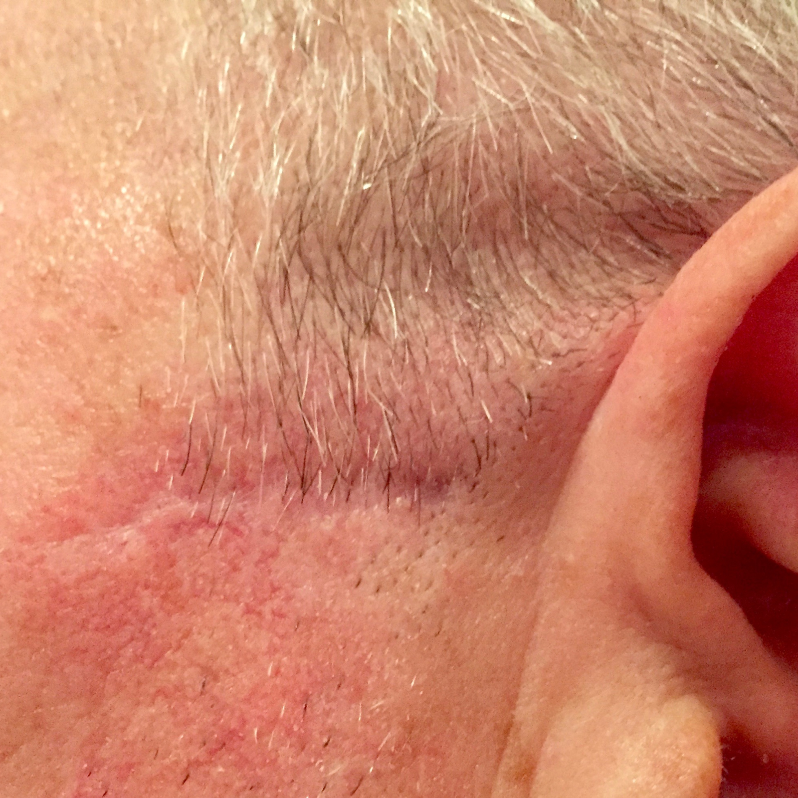 Műtét – melanoma eltávolítás – végeredmény